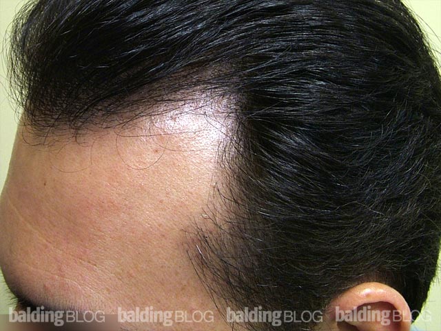 Temple Hair Loss and Transplantation (with Photos) – WRassman,.  BaldingBlog