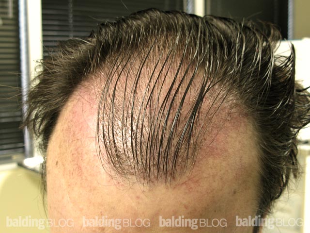 Scabs After Hair Transplant (with Photos) – WRassman,. BaldingBlog