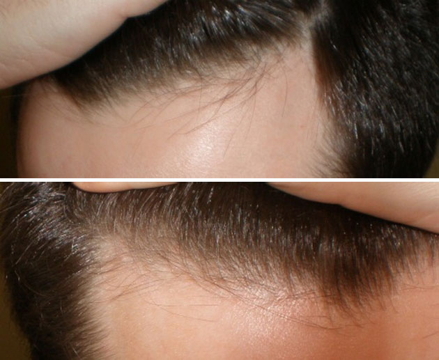 normal hairline vs receding