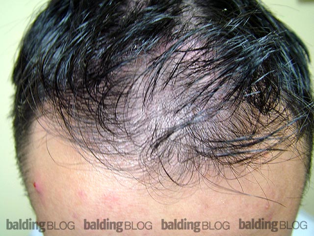 Reversal of Frontal Hair Loss from Propecia (with Photos) – WRassman,.  BaldingBlog