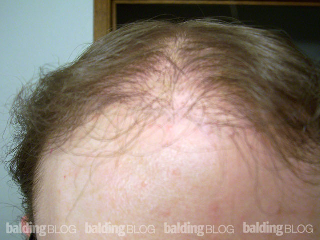No Growth 7 Months After from My Hair Transplant (with Photos) –  WRassman,. BaldingBlog