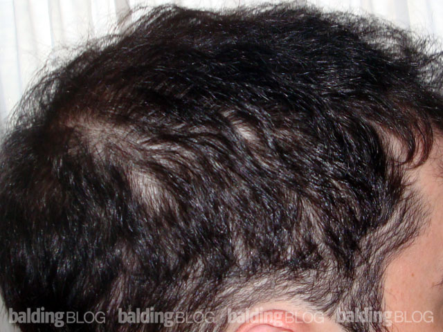 After Starting Propecia, I'm Thinning on the Back and Sides Too! –  WRassman,. BaldingBlog