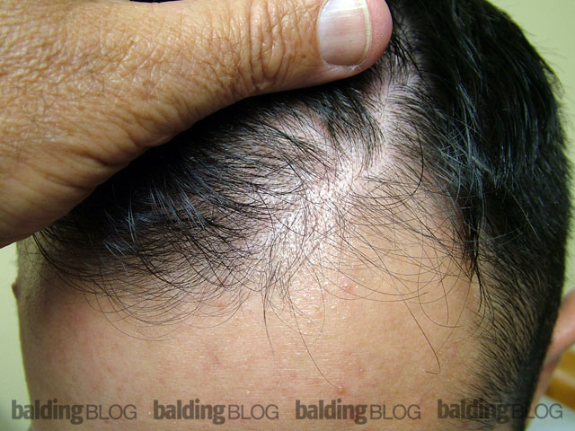 Update: Reversing Frontal Hair Loss with Propecia (with Photos) –  WRassman,. BaldingBlog