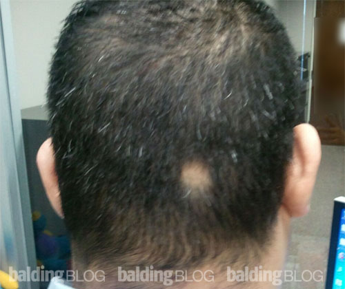 Of on back bald head spot Potential Causes