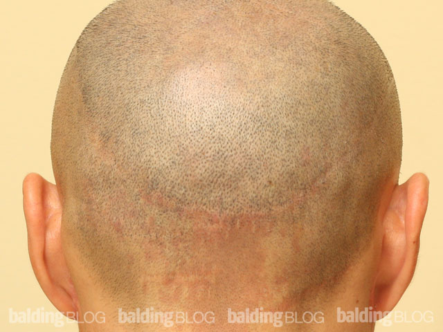 Scalp Micro-Pigmentation Use in Covering Scars (with Photos) –  WRassman,. BaldingBlog