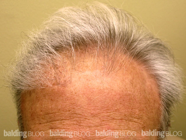 Repairing Old Plugs Placed Too Low at the Hairline (with Photos) –  WRassman,. BaldingBlog
