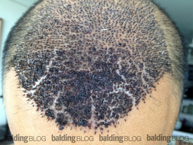 I Have a Lot of Scabbing a Week After My FUE Procedure (with Photo) –  WRassman,. BaldingBlog
