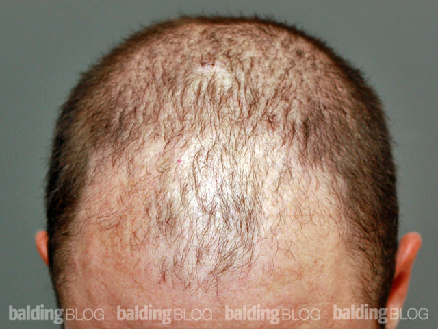How is Failed Hair Transplant Corrected  Cyber Hairsure