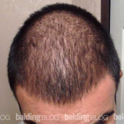 My Hair Is Now Growing Slowly All Over My Head and Body (with Photos) –  WRassman,. BaldingBlog