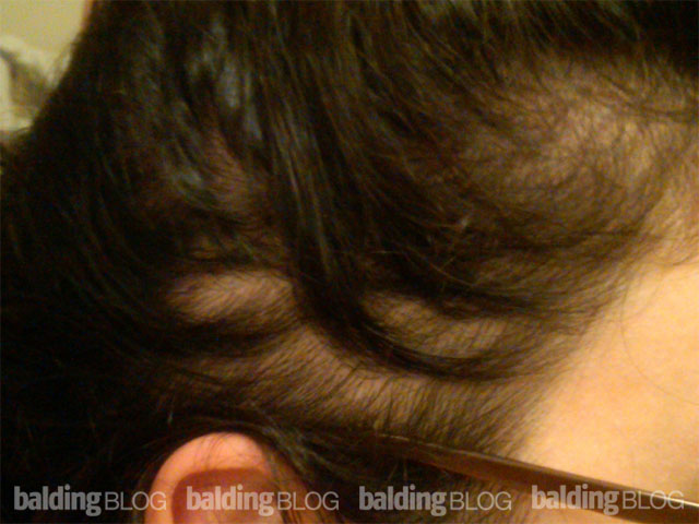 I Stopped Taking Synthroid  Years Ago and I'm Still Having Female Hair  Loss! – WRassman,. BaldingBlog