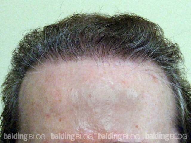 Father and Son Hair Transplants (with Photos) – WRassman,M.D. BaldingBlog