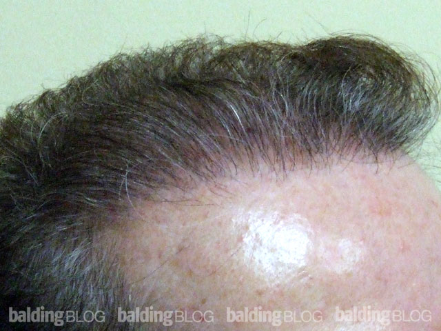 Father and Son Hair Transplants (with Photos) – WRassman,M.D. BaldingBlog