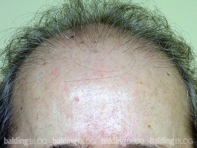 Father and Son Hair Transplants (with Photos) – WRassman,M.D. BaldingBlog