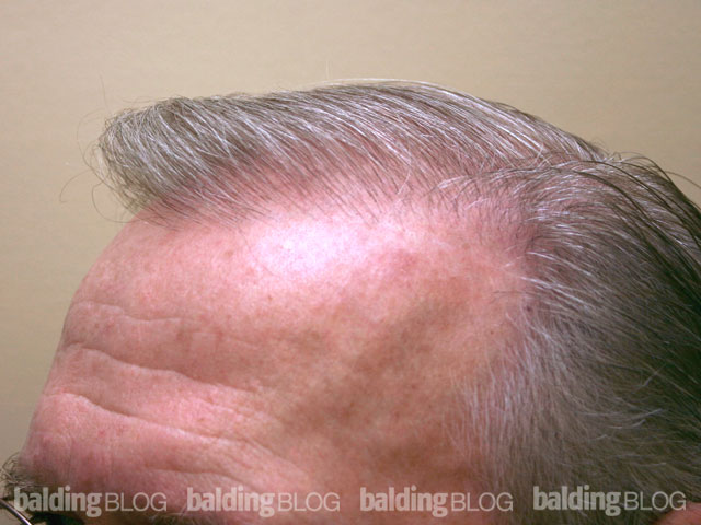 Single Session Hair Transplant (with Photos) – WRassman,M.D. BaldingBlog