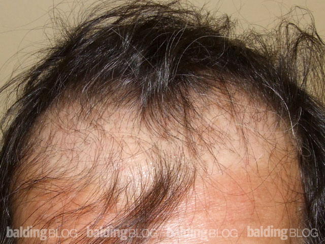 Unnatural Looking Balding Pattern (with Photos) – WRassman,M.D. BaldingBlog