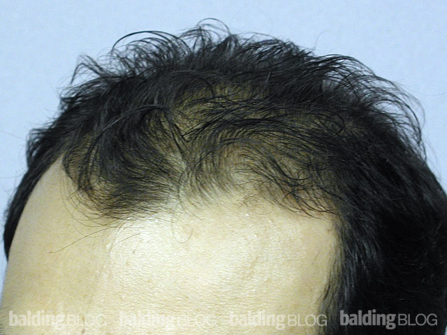 Hair Transplant and Propecia Combination Results (with Photos ...