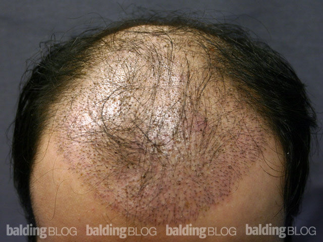 10 Days After Hair Transplant (with Photos) | WRassman,M.D. BaldingBlog