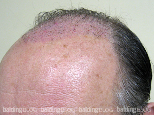 Patients After Hair Transplantation (with Photos) – WRassman,M.D ...