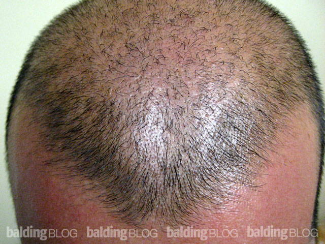 Persistent Juvenile Hairline With Photos Wrassmanmd Baldingblog 7540