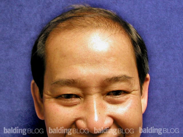 Transplanting Asian Hair (with Photos) | WRassman,M.D ...