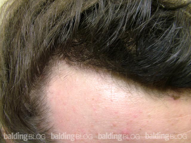 Transplanting the Frontal Corner, 6 Months Post-Op (with Photos ...