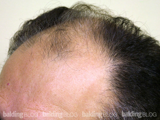 Hair Transplant Results After Just 1 Procedure (with Photos) – WRassman ...