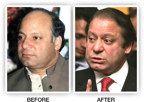 Former Pakistan Prime Minister Nawaz Sharif Had a Hair Transplant? –  WRassman,. BaldingBlog