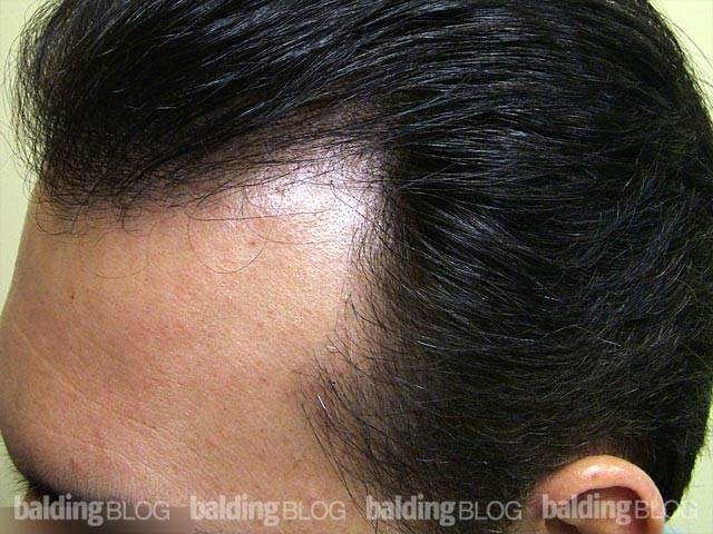 Temple Hair Loss And Transplantation With Photos Wrassmanmd Baldingblog 2360