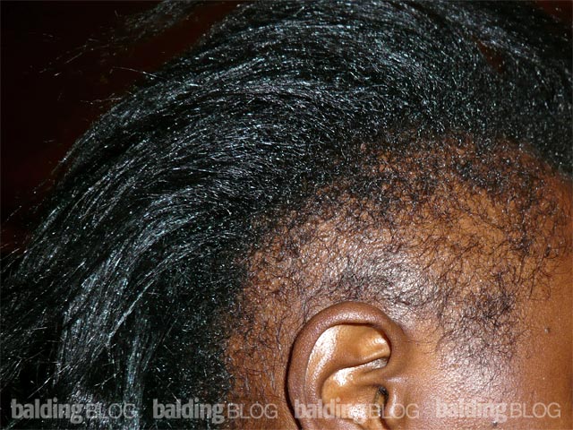 Woman Losing Hair on the Sides (with Photo) – WRassman,M.D. BaldingBlog