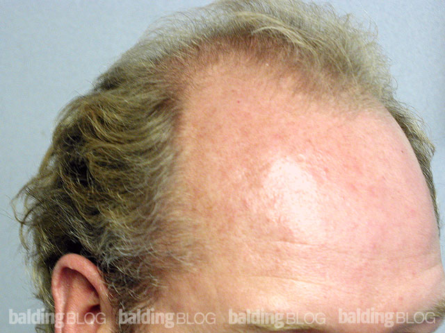 Looking Younger After Hair Transplants (with Photos) – WRassman,M.D ...