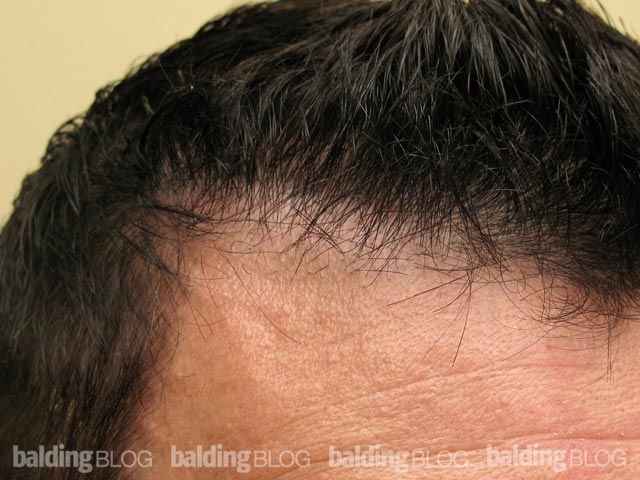 How to Fix a Pluggy Hairline (with Photos) – WRassman,M.D. BaldingBlog