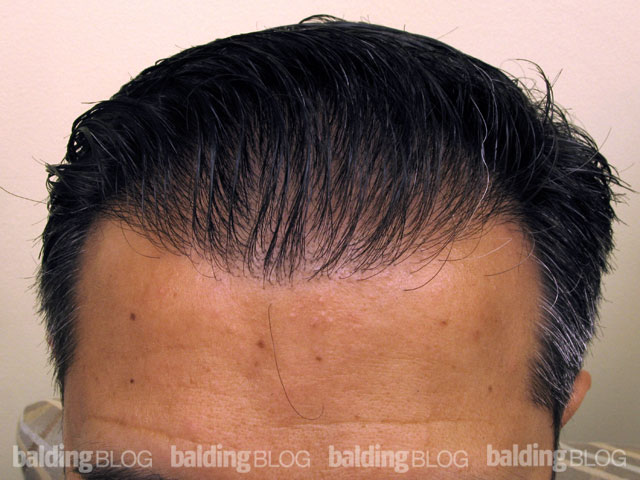 Why Do Hair Transplant Patients Always Comb Their Hair Back? (with 