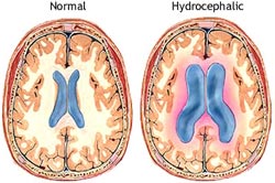 Hydrocephalic vs Normal