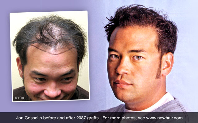 Jon Gosselin - Before and After Hair Transplant