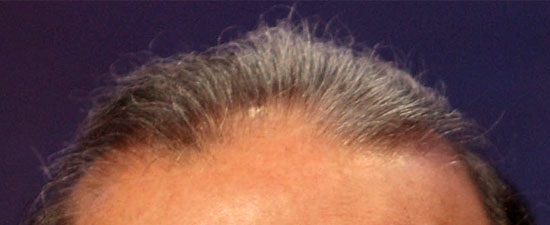 Carlos Slim hairline
