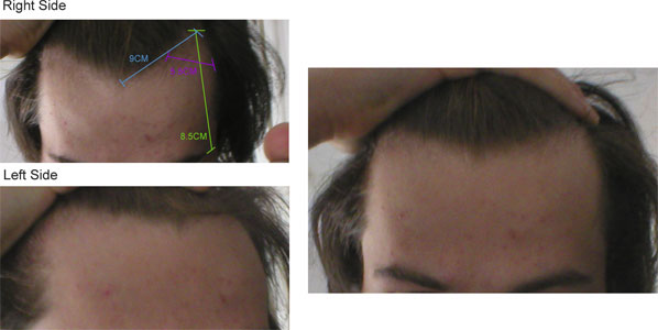 Hairline at 18 receding Receding Hairline