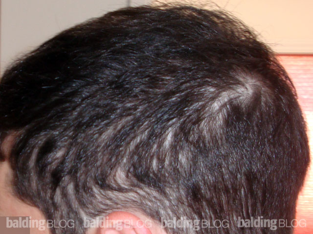 can stopping zoloft cause hair loss