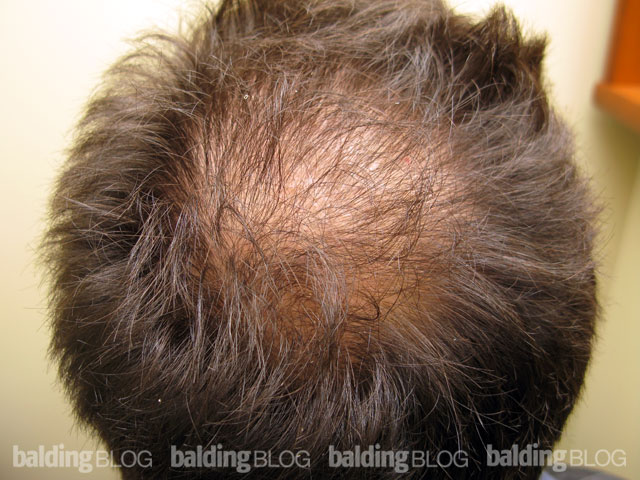 Densely Packed Hair Transplant? (with Photos) – WRassman,M.D. BaldingBlog