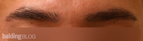 Male Eyebrow Transplants (with Photos) – WRassman,M.D. BaldingBlog