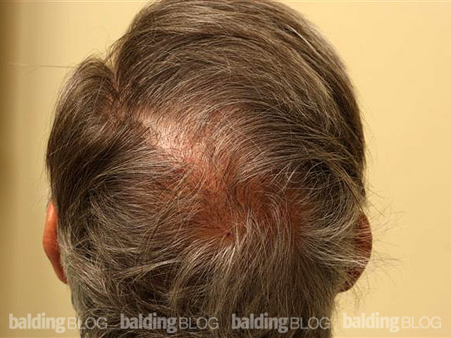 Follow-Up — Dr Rassman’s Recent Hair Transplant (with Photos ...