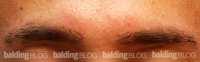 Eyebrow Transplant Of 189 Grafts (with Photos) – Wrassman,m.d. Baldingblog