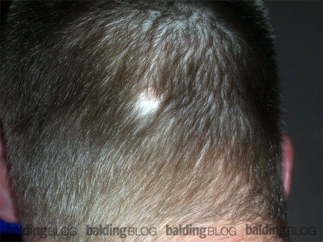 I Found a Bald Spot in the Back of My Head (with Photo) | WRassman,M.D