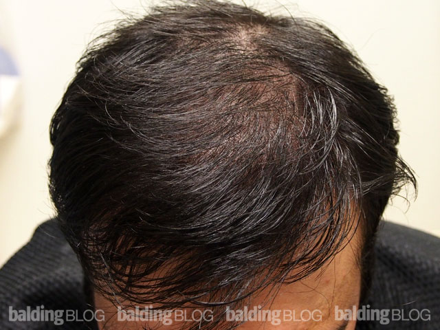 A Remarkable Change Made from SMP on a Thinning Scalp (with Photos ...