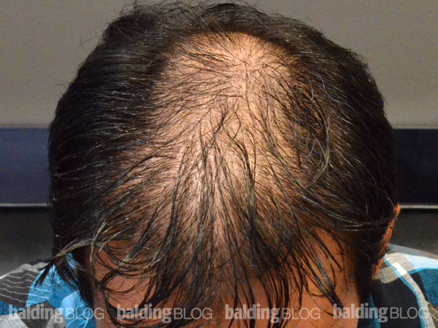 A Remarkable Change Made from SMP on a Thinning Scalp (with Photos ...