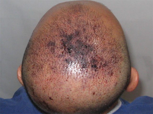 Is This Necrosis After My Hair Transplant? – WRassman,M.D. BaldingBlog