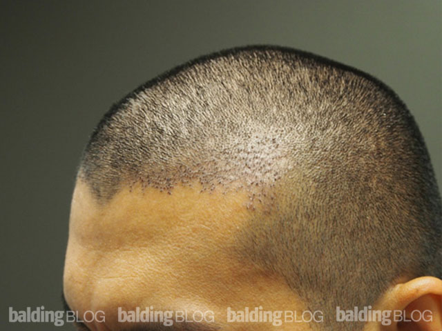 Class 2/3 Patient Just 5 Days After FUE Procedure (with Photos ...