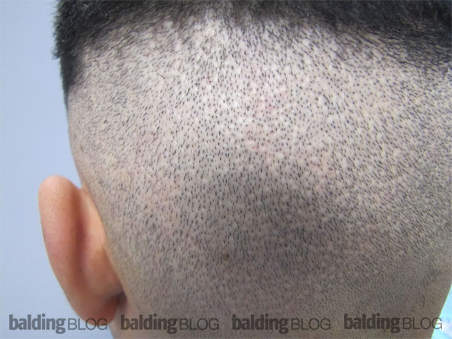 dot-scarring-from-a-large-fue-procedure-with-photo-wrassman-m-d