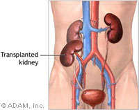 Kidney transplamt