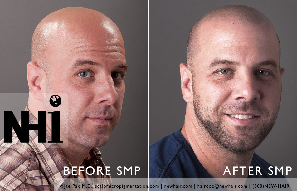 SMP before and after