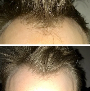 Treated with minoxidil, finasteride and the Dermapen over three months  (with photos) – WRassman,. BaldingBlog